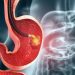 Gastritis bol u stomaku