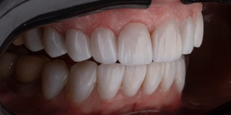 Zubni cirkoni zubar