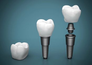 5 RAZLOGA ZAŠTO SU ZUBNI IMPLANTI POPULARNO I NAJBOLJE REŠENJE ZA NADOKNADU ZUBA